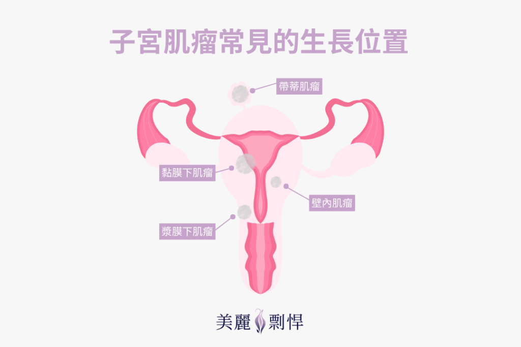 子宮肌瘤常見的生長位置