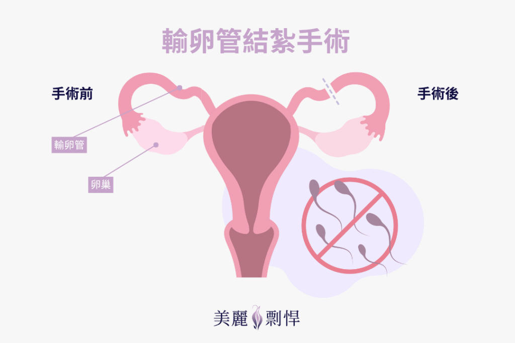 婦產科輸卵管結紮手術流程示意：手術前後輸卵管阻斷對照圖