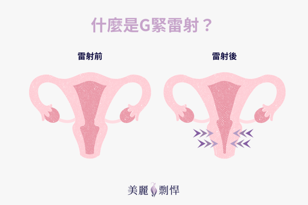 什麼是G緊雷射？示意圖比較治療前後陰道與骨盆支持組織的緊實變化